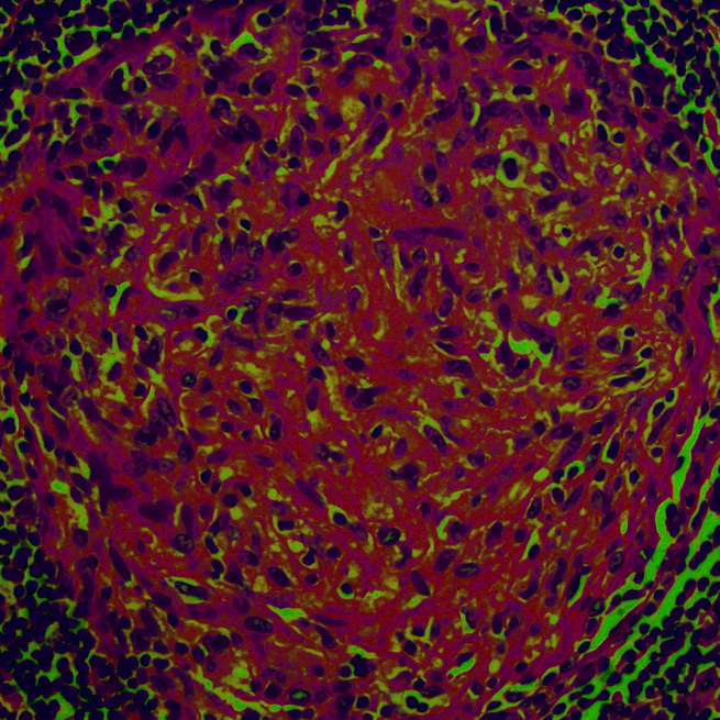 🦠 Granuloma, un poema sobre la inmunidad